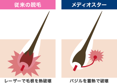 従来の脱毛とメディオスターの脱毛比較図
