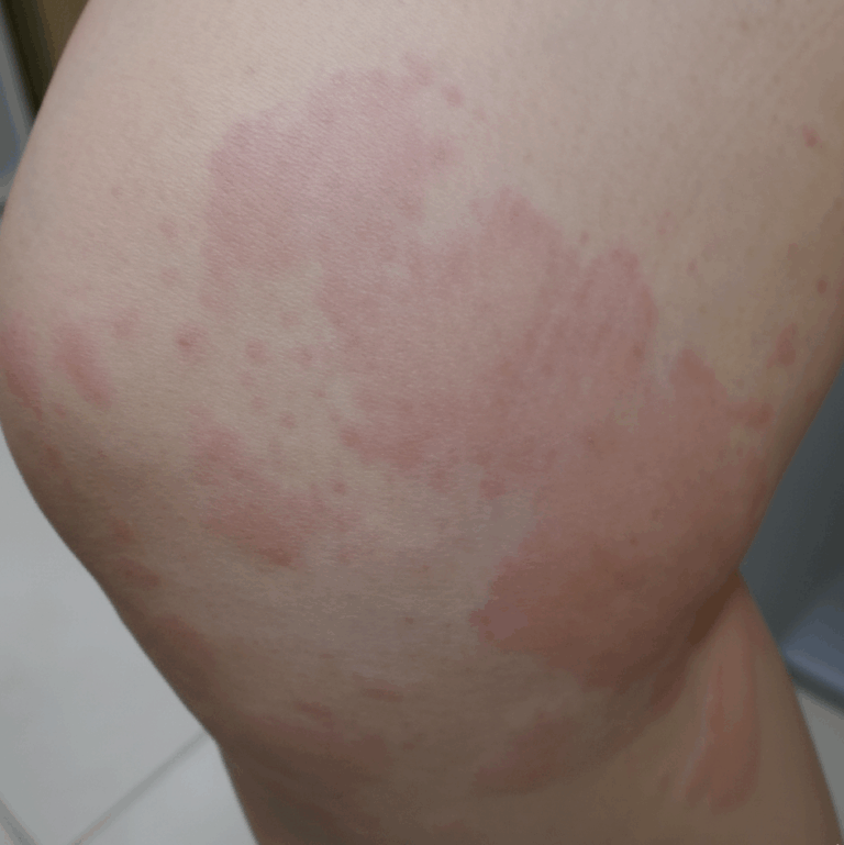 じんましんで腕に境界のはっきりした赤い膨疹が出ている状態のイメージ図