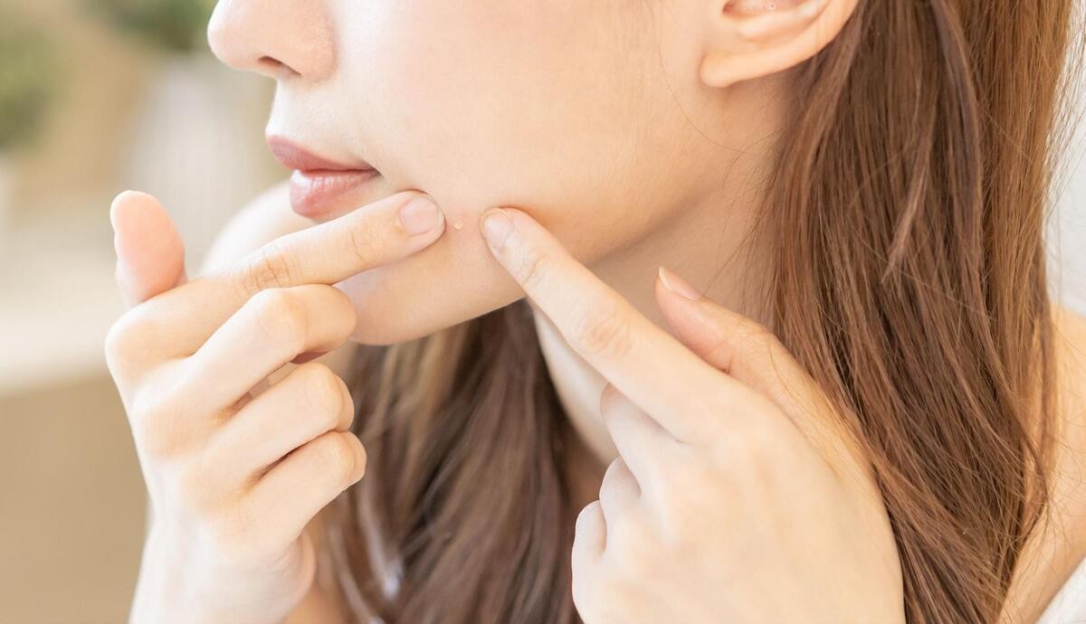 ニキビの白い塊を押し出そうとしている