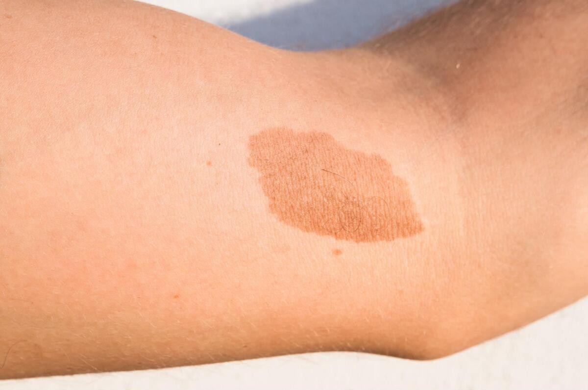 あざを早く治す方法は？色の違いや回復のためのセルフケアも紹介