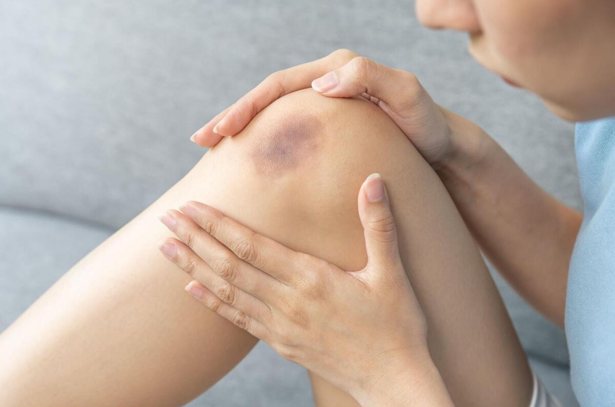 膝にできたあざ