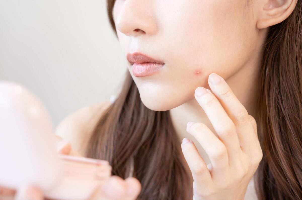 ニキビの白い塊の正体は？原因と対処法・治療法から予防策まで解説