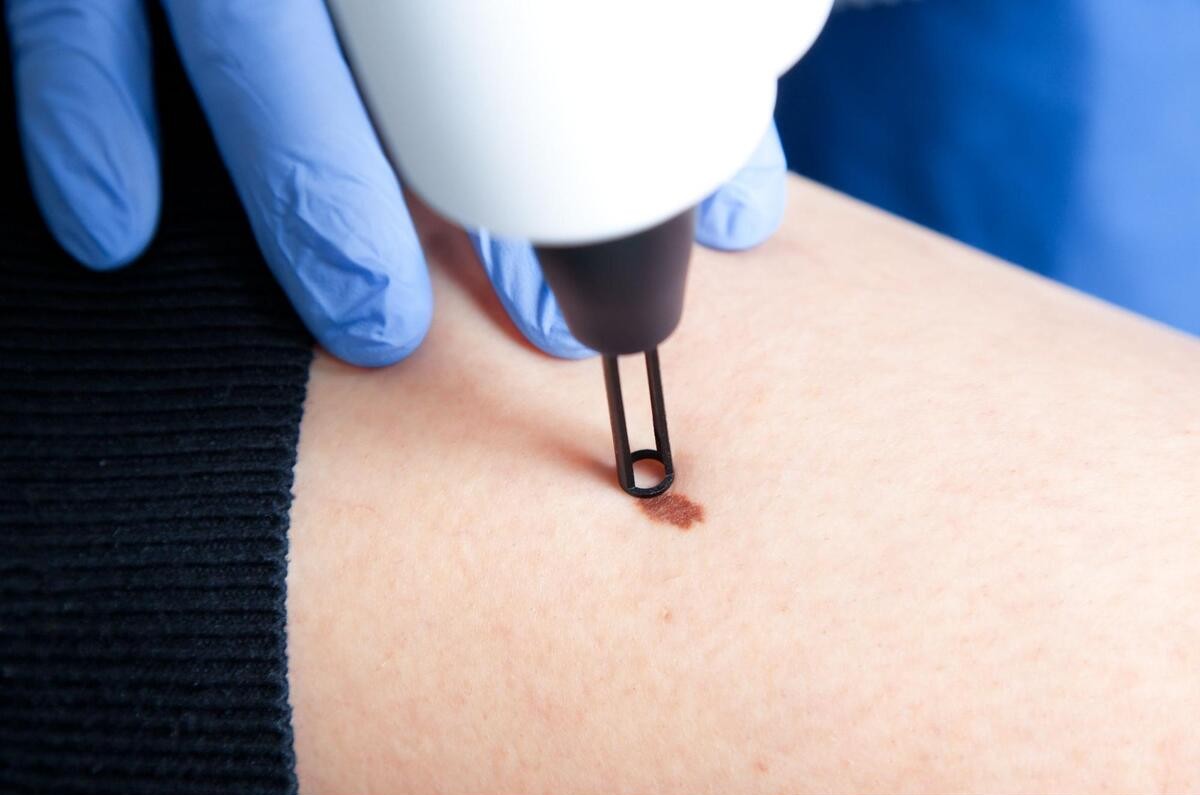 シミ取りの治療を受けている様子