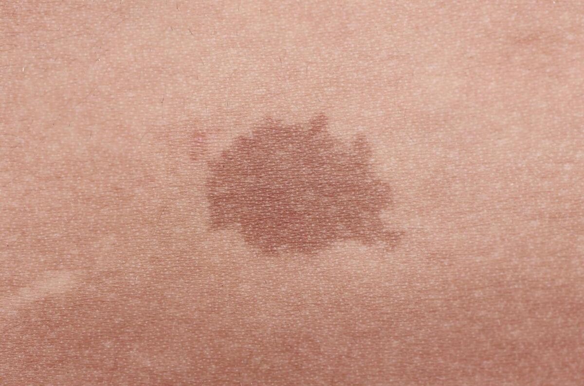 生まれつきのあざ