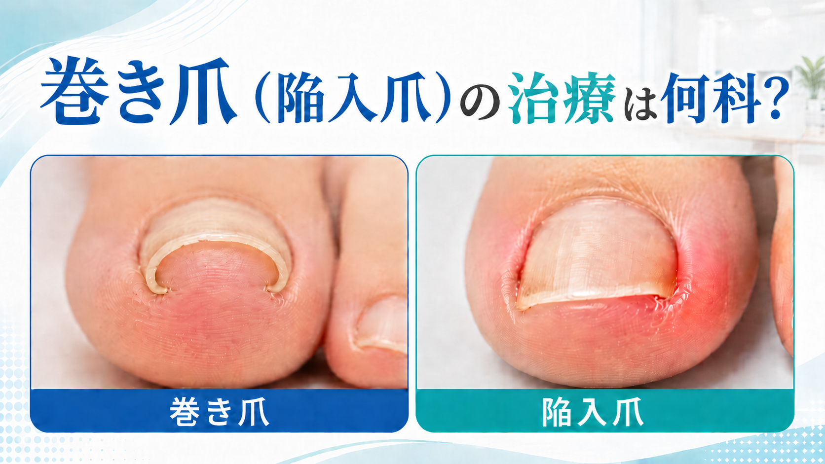 巻き爪は何科に行けばいい?受診先の選び方と外科的処置の注意点を皮膚科医が解説